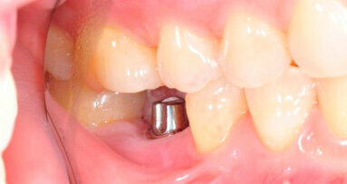 Oltre il 60 per cento dei dentisti esegue procedure di impianto dentale