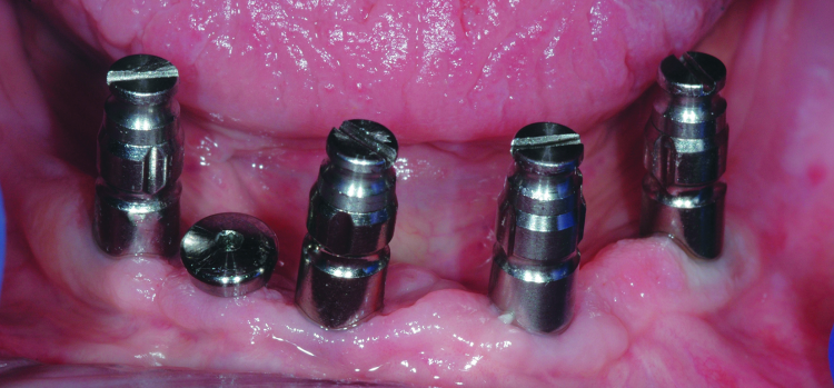 Fig. 4: Open tray impression copings seated on the dental implants. One implant is selected for disuse and covered with a transmucosal abutment.