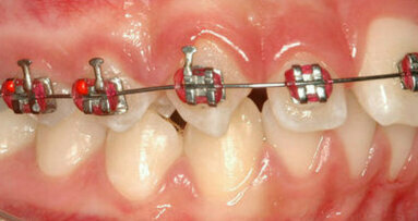 Alerta sobre aplicação ilegal de aparelhos dentários