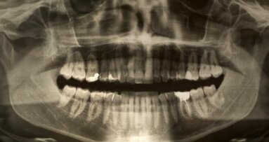 Chirurgen trekken 232 ‘tanden’ bij Indiase jongen