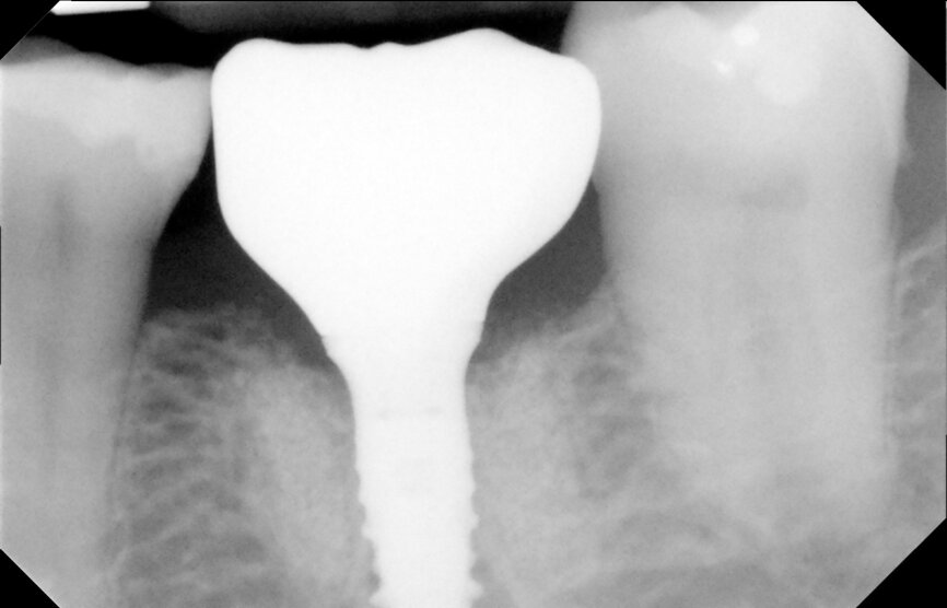 Fig. 29: One-year follow-up radiograph showed peri-implant stability.