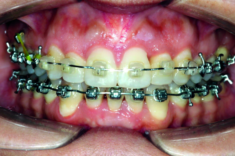 Fig. 3: nHAp agent by PrevDent can be used also during orthodontic treatment.