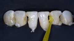 Simplified direct restoration procedure in the mandibular anterior region with CLEARFIL MAJESTY ES-2 Universal