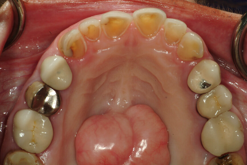 Fig. 14: Significant wear requiring occlusal coverage and altering
of occlusion.