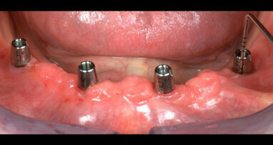 Implant-supported mandibular complete prosthesis with conometric retention after three years