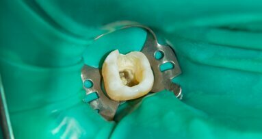 Endodontists stress importance of closing dental dam gap