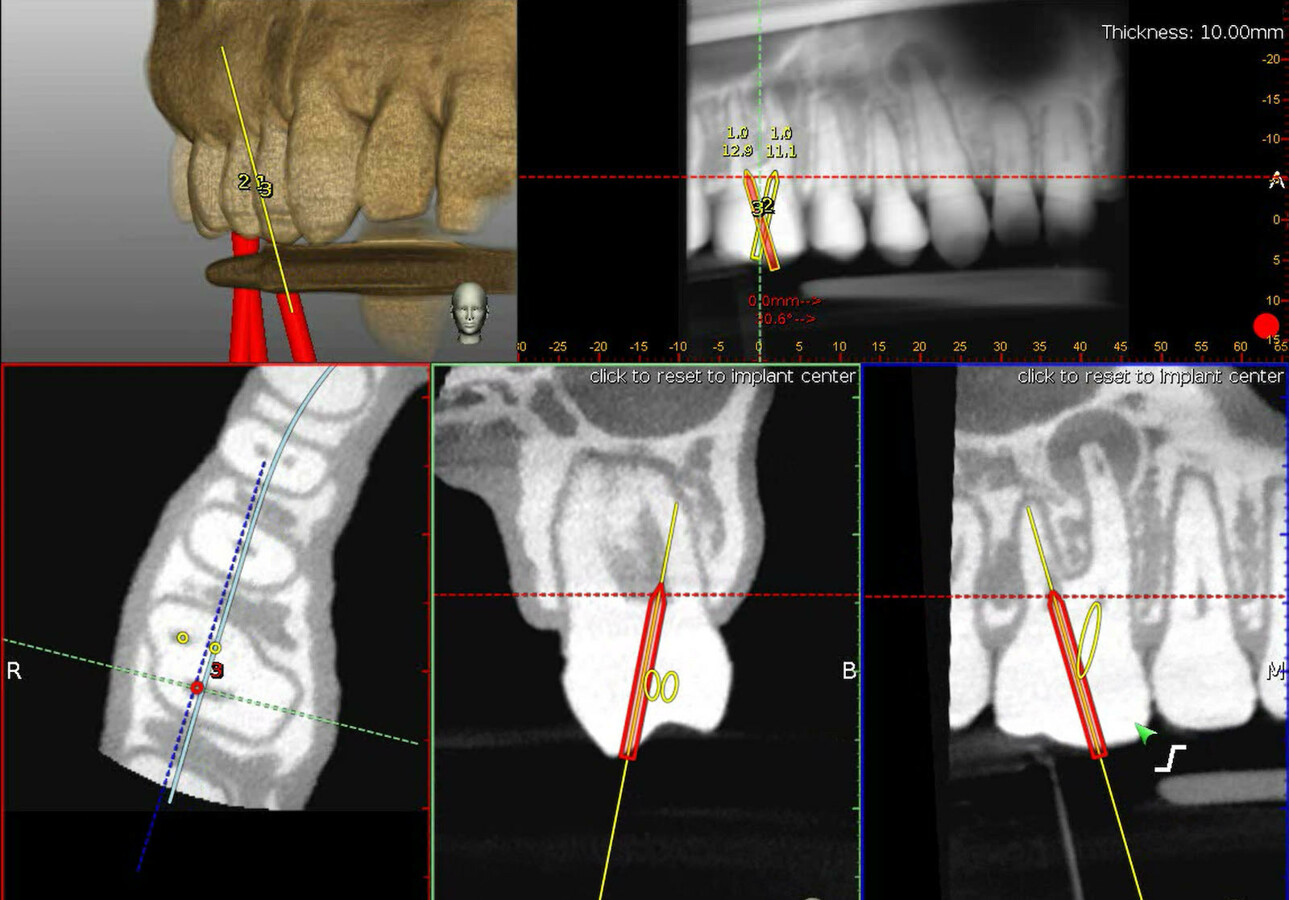 Dynamic navigation—The future of minimally invasive endodontics