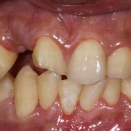 Esthetic Rehabilitation of Maxillary Anterior Teeth: Dr Sanjay Sah
