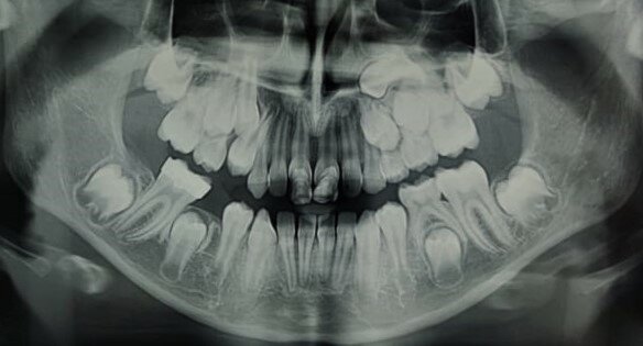 Figg. 1a, 1b - Rx-OPT della paziente 1 (A) e della paziente 2 (B) gemelle di anni nove e mezzo entrambe in trattamento ortodontico intercettivo. Si nota la particolare e contemporanea presenza sia della trasposizione canina-premolare sia della ritenzione canina superiore.