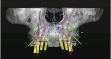 Técnicas quirúrgicas en el maxilar atrófico