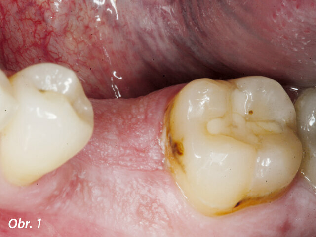 Počáteční klinická situace po zhojení extrakční rány v místě zubu 36: Alveolární kost byla široká a v místě byl dostatek keratinizované gingivy.