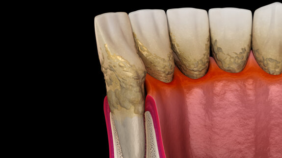Researchers to develop novel antibiotic delivery system to treat aggressive periodontitis