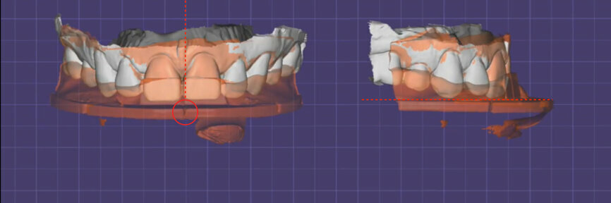 Fig. 8: Scanned model and index tray bite record showing the corresponding facial midline determined by the middle notch of the index tray and the occlusal
plane determined by the base of the index tray.
