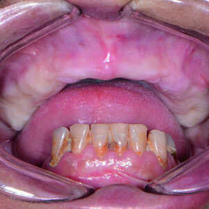 Fig-2-Vue-préopératoire-avec-écarteur-de-lèvres-sans-prothèse-300x300-