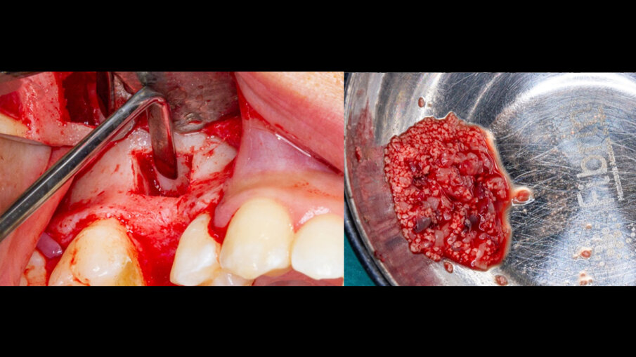 Obr. 2a, b: Osteotomie provedená piezoelektrickou chirurgií a Sticky Bone k rekonstrukci.
