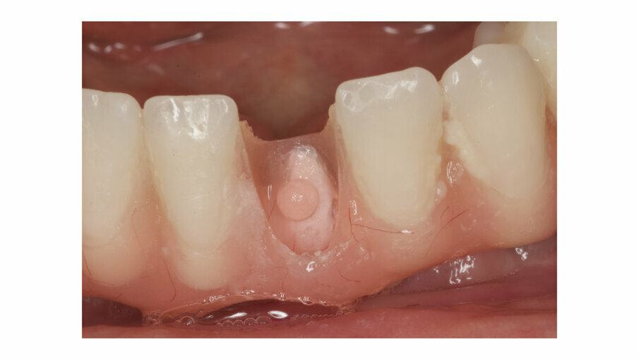 Fig. 12: Debonding of prefabricated tooth is very common on overdentures.
