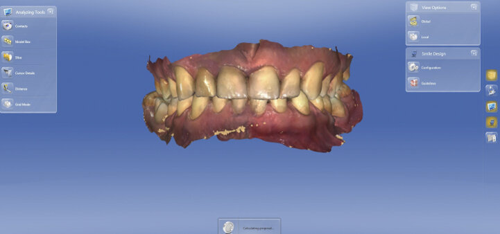 Fig. 3: Buccal scan: information on the positioning of the maxilla relative to the mandible. This is absolutely necessary for designing a crown.