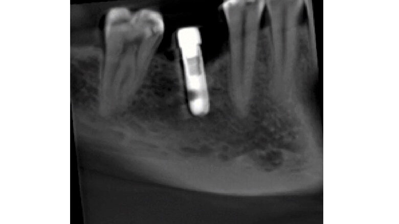  Fig 3. Tomografía a los 4 meses. El halo hipodenso en la parte distal del implante ya no está tan marcado, sobre todo en la parte inferior del implante, es decir, que hubo una reduccion de esta zona; además, observamos un leve aumento de la densidad ósea en la zona mesial y distal del implante a nivel del reborde. Se realiza terapia de fotobioestimulacion con láser de diodo en la zona.