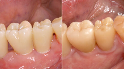 First long-term study on two-piece zirconia implants published