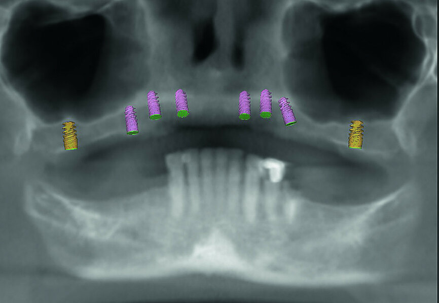 Fig. 3: Proposed treatment of maxillary arch.