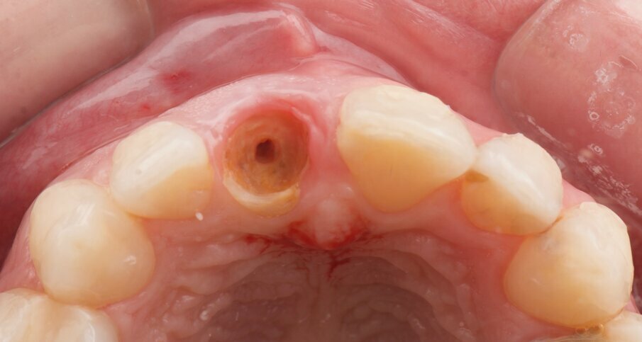 Fig. 17: Intra-oral view after removal of the horizontally fractured tooth #21. 