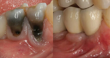 A surgical approach to the management of periapical implant lesions