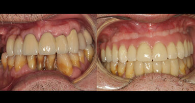 Tratamiento con all-on-four de paciente con dentición terminal