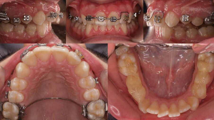 Fig. 2 - Il bondaggio della resina (Triad Gel, Dentsply) avviene contemporaneamente all’applicazione di parti dell’apparecchio fisso. La barra transpalatale espande la dimensione trasversale intermolare e il segmento anteriore con anse rettangolari inizia l’allineamento del settore anteriore superiore. Tutto questo avviene mentre la resina consente un riposizionamento anteriore della mandibola. Nota: Il Triad Gel, Dentsply non è attualmente in commercio, e lo abbiamo sostituito con l’Orthocryl LC, Dentaurum.