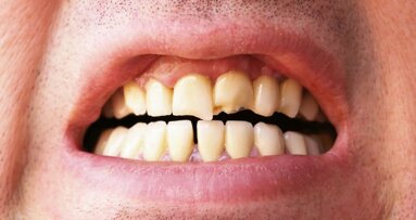 Предстоят клинични проучвания върху зъби с установени пукнатини