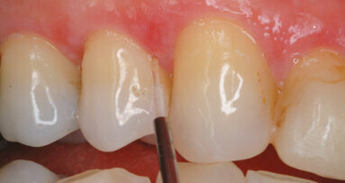 Diode lasers for periodontal treatment: the story thus far