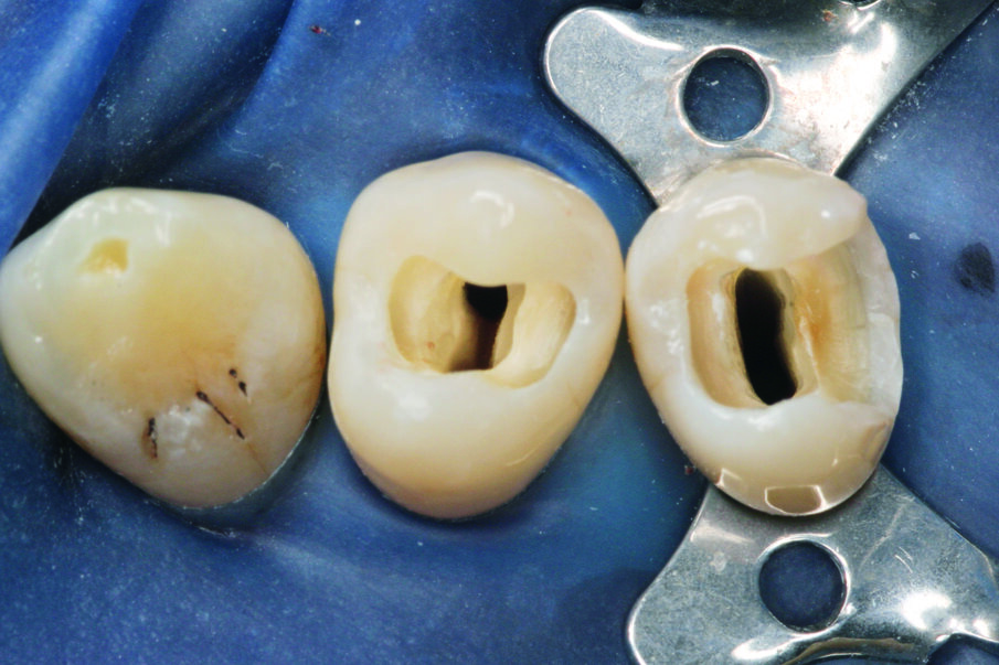 Fig: 1. Direct restorations Class I and II after endodontic treatment. The access cavities show the root canals.