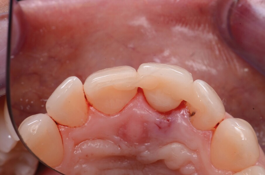 Fig. 7a : Une dent en composite est solidarisée aux dents adjacentes, avec un renforcement en fibre de verre puis recouverte d’un composite fluide.