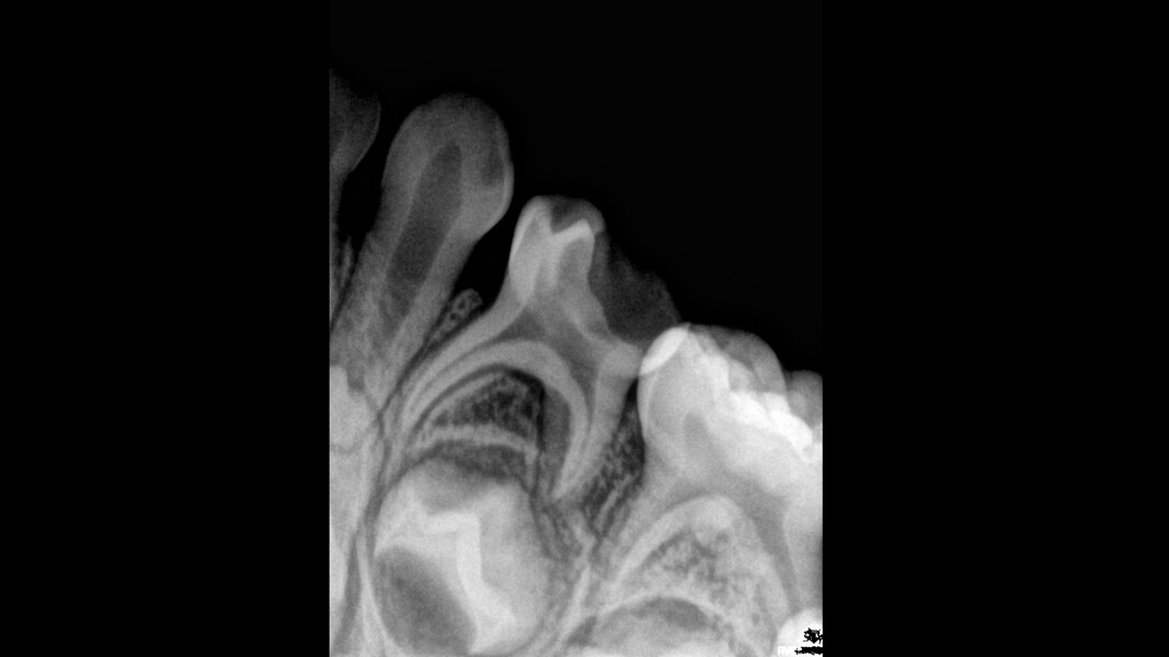 Fig. 15: Initial radiograph showing compromised pulp chamber.