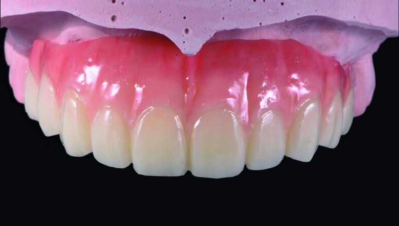 Fig 19.  Completed Provisional Profile Prosthesis with gingival aesthetics that mimic nature 