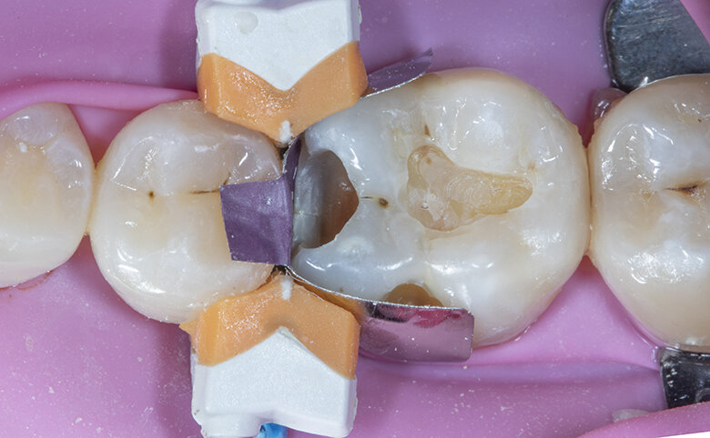Fig. 5. Band from premolar was removed and molar band burnished with light to medium pressure on the adjacent premolar tooth to ensure proper contour and contact.