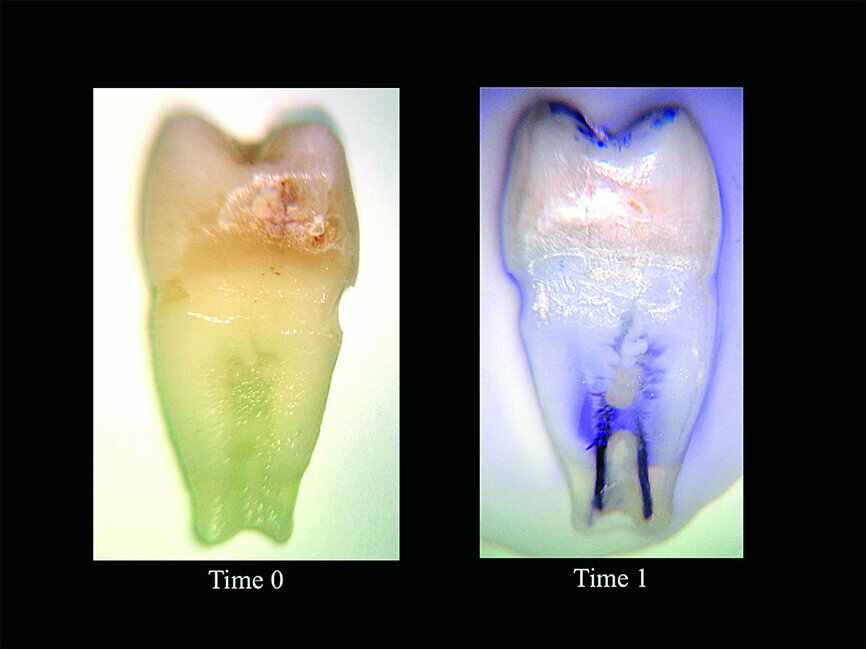 Fig. 2a: Sleiman-Iandolo testing.
Freshly extracted premolar dyed
with methylene blue in a centrifuge.
Note the deep penetration of the dye,
especially in the coronal part.