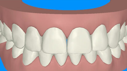 ZIRCONITE - Colore dentina - Henry Schein Krugg S.r.l.