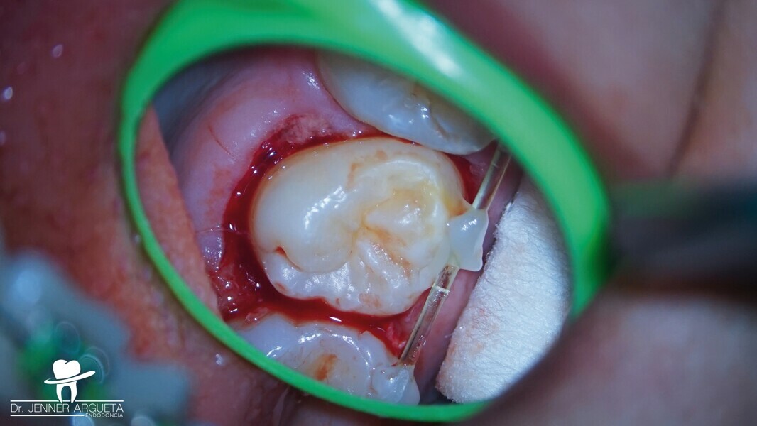Fig. 4 : Une contention flexible constituée d’un monofilament en nylon est utilisée pour stabiliser la dent transplantée dans le site receveur.
