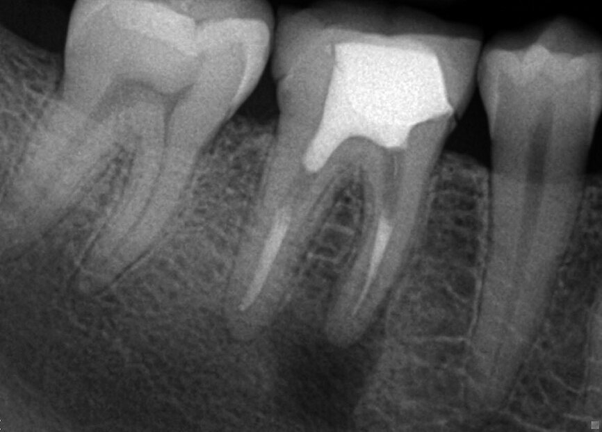 Fig. 7: A failing root canal treatment with apical infection and an internal resorption in the apical area.