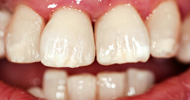 Přímé kompozitní rekonstrukce u pacientů po ortodontické terapii