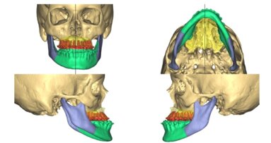 Zastosowanie technologii 3D oraz CAD/CAM w  chirurgii ortognatycznej – opis przypadku