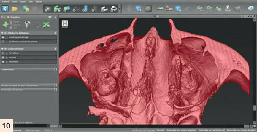 Vérification 3D après chirurgie sur CodiagnostiX, situation très proche de la planification initiale.