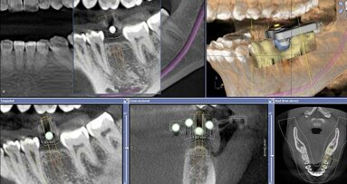 Guided implant surgical placement with CAD/CAM CEREC crown