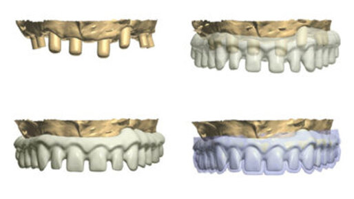 DT News - International - The use of CBCT and CAD/CAM techniques in ...