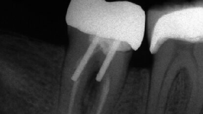 Hlavní zásady, které zvyšují úspěšnost rekonstrukce endodonticky ošetřených zubů