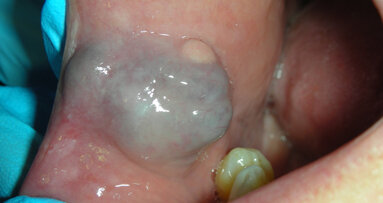 Il trattamento micro-invasivo degli emangiomi orali effettuato con laser a diodi: due case report