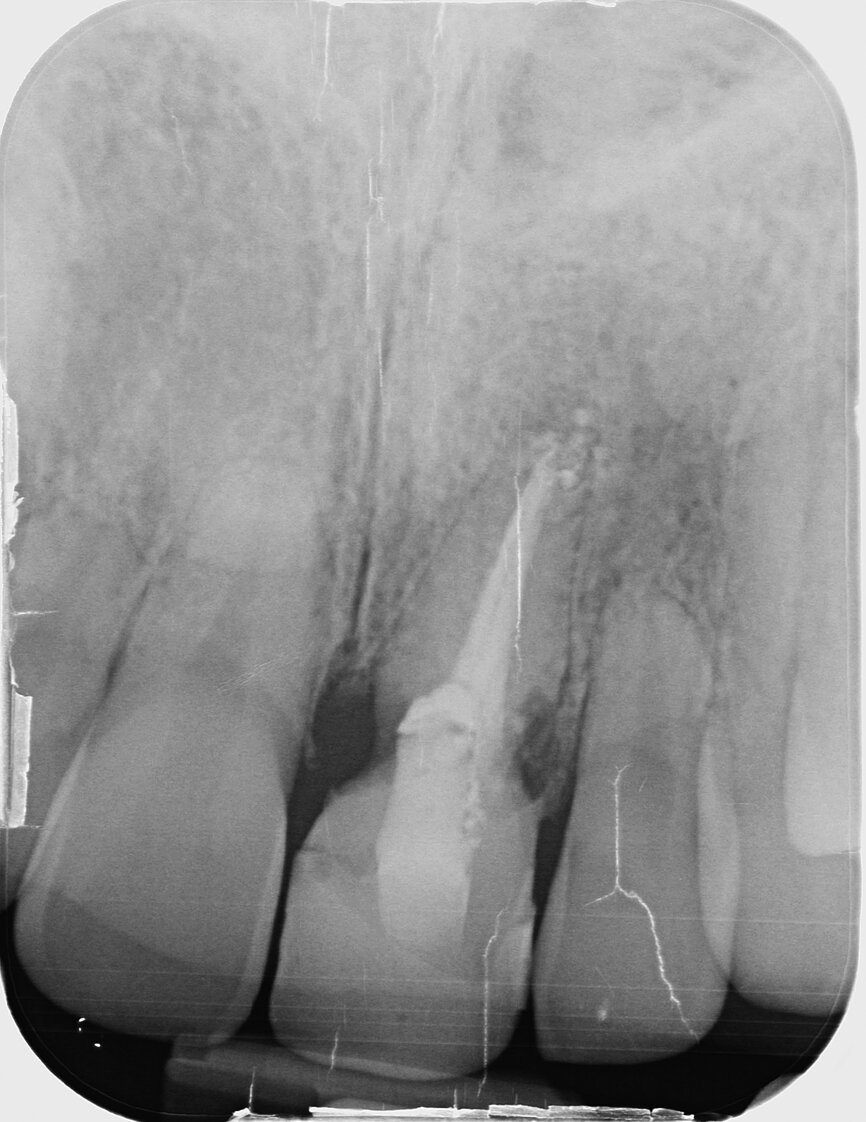 Fig. 1: Single-tooth exposure of tooth #21 after recurrent marginal gingivitis. Owing to the initial diagnosis of extensive resorption, the tooth could not be preserved.