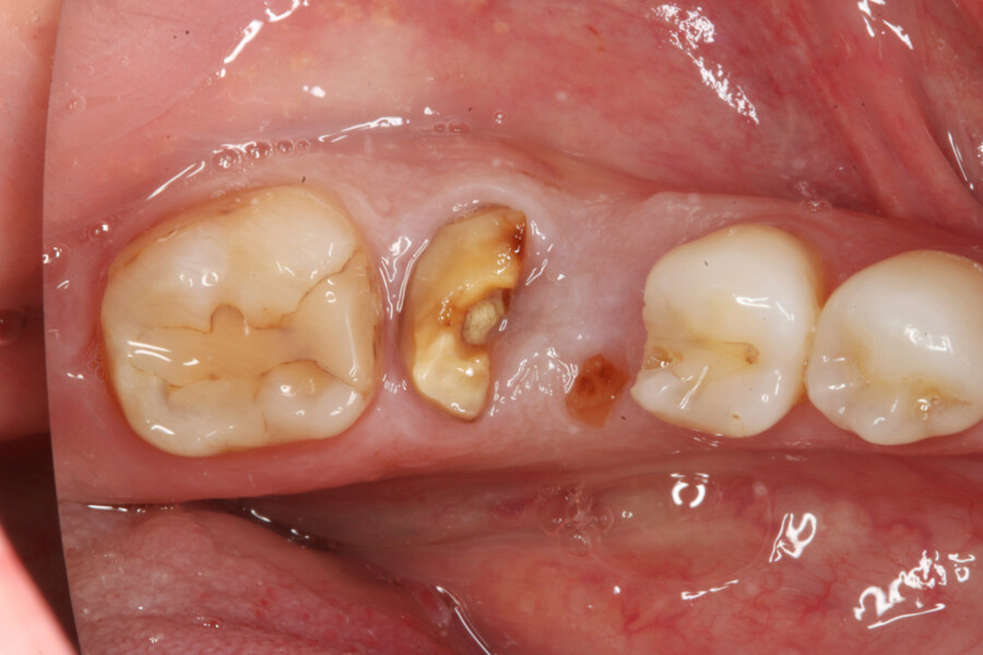 Fig. 1: Deeply fractured mandibular first molar.