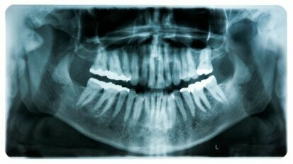 Analyse van tandheelkundige röntgenfoto’s door AI bespaart tijd in patiëntenzorg