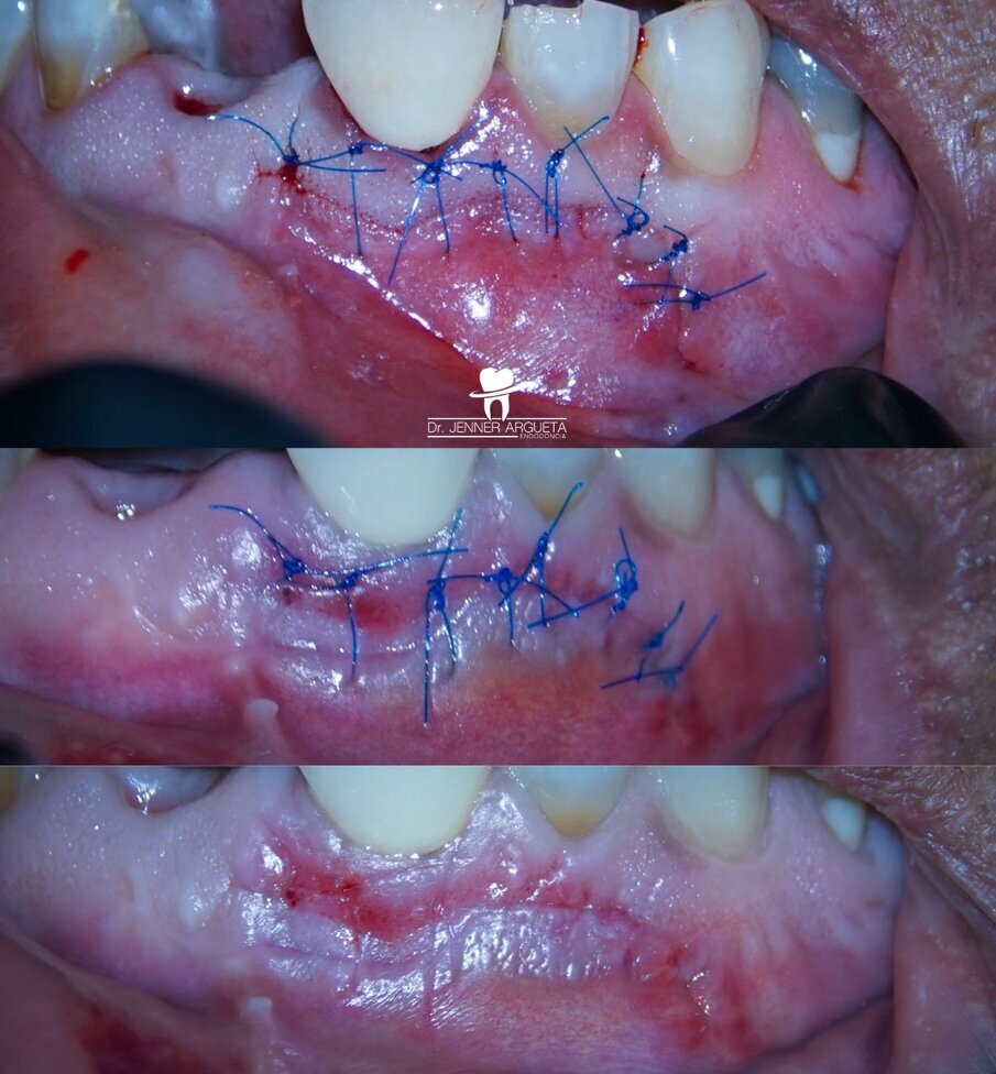 Figs. 14a–c: Post-op suturing sequence. Immediate post-op suturing (a). Five-day follow-up clinical image, just before the suture removal (b). Clinical image immediately post-suture removal, showing good healing of the area (c).